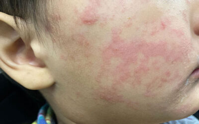 What Every Mom Needs to Know About Measles